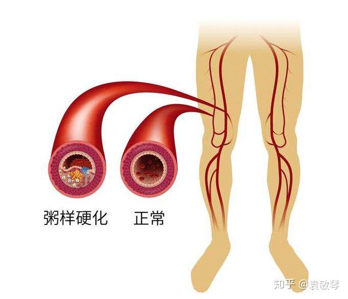 糖尿病检查出下肢动脉病变要紧吗 知乎