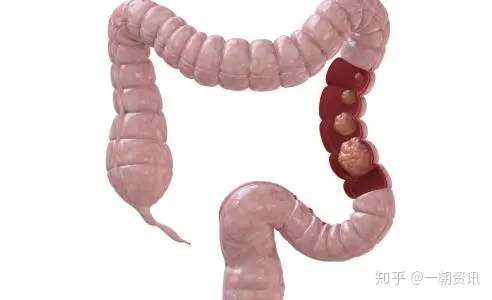 排便时有3种表现要重视若一个都没有说明肠道健康