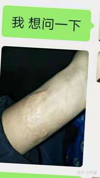 我朋友小时手臂被开水烫伤了留下了疤痕 ,这个当兵体检能过吗?