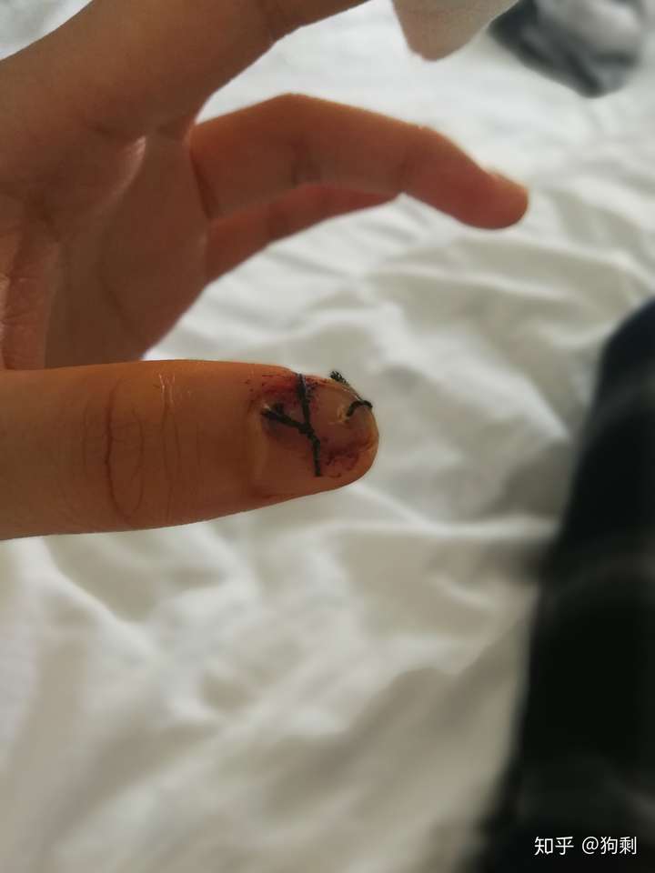 手指被刀削去一块肉贴回去可以长好么