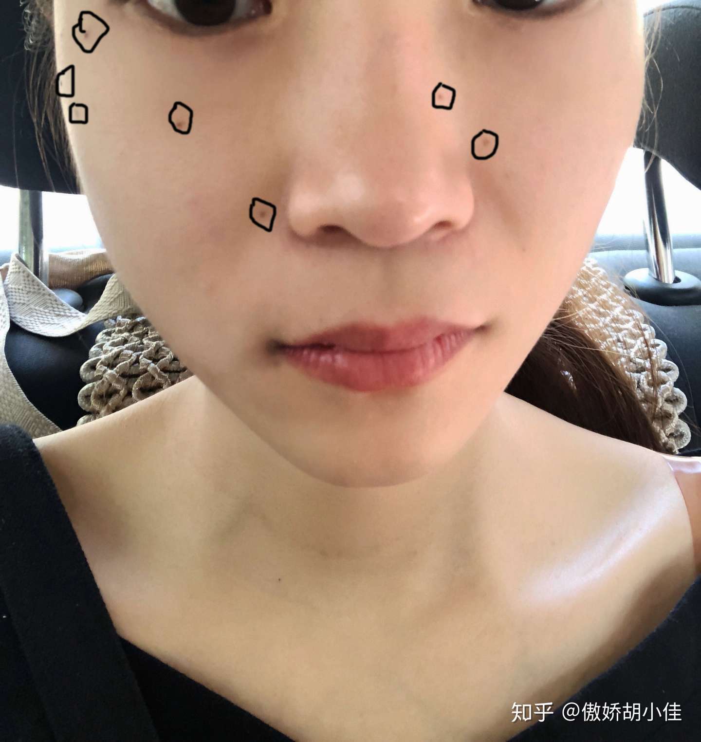 我的祛痣全记录 大家一定要注意这些 知乎