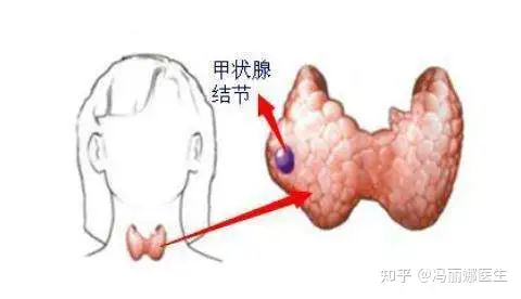 甲状腺结节如何调理比较好？中医医师：这么做有利于散结！（甲状腺结节怎么散节）