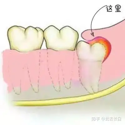 常因阻生或者存在盲袋現象,又由於位置靠後,智齒無法完全萌出時,和