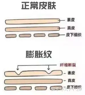 为什么会出现肥胖纹减肥过程中又该如何避免