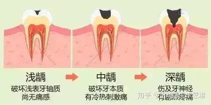 牙齒結構示意圖67編輯齲齒表現症狀是不同的,根據齲齒破壞的程度,可