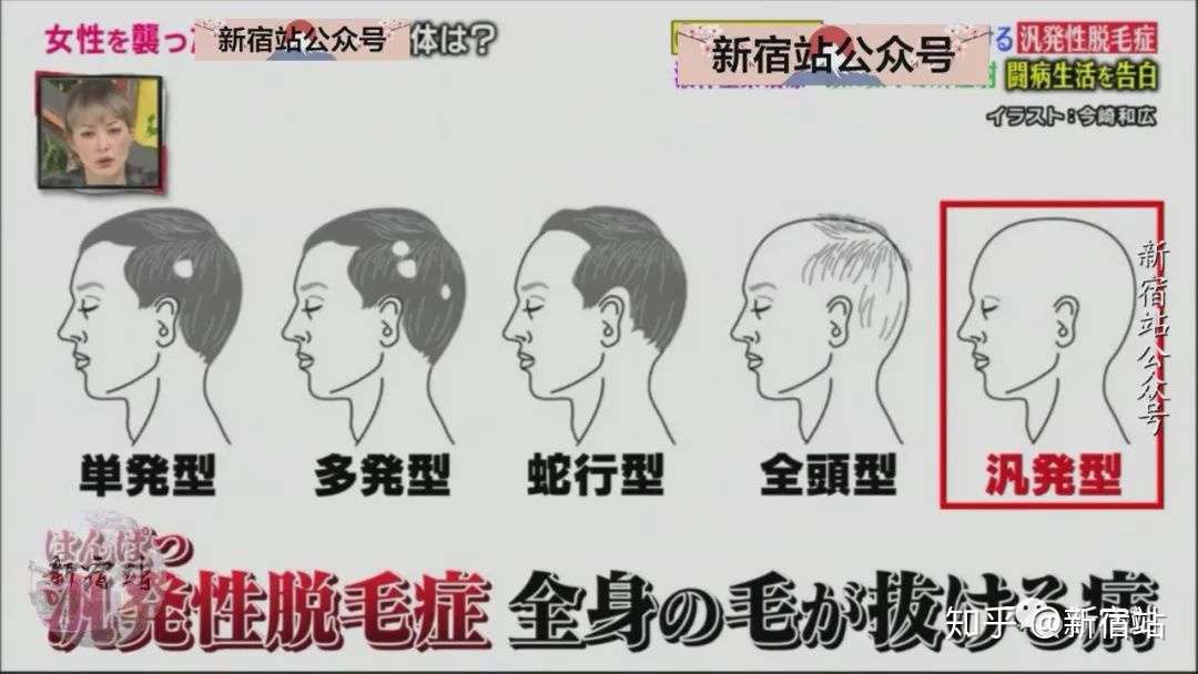 患有脱发症的日本女性 跌入人生谷底再重新爬起 知乎