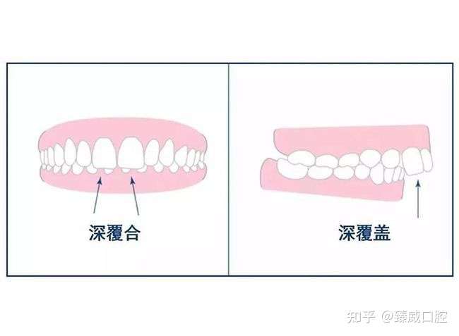 牙齒正畸,弄不清楚深覆蓋和深覆合之間的區別?