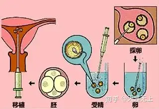 成都借卵试管婴儿（试管婴儿真的适合所有人吗？）