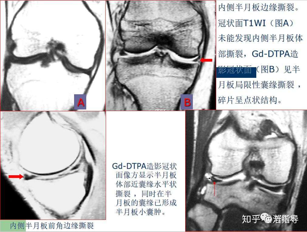 膝关节半月板损伤核磁诊断要点详解与治疗分析 知乎