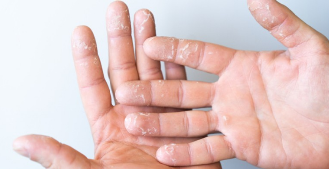 手部干燥、瘙痒脱皮，选对护手霜才能有效缓解