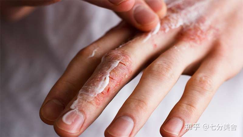 如何进行手部护理 知乎
