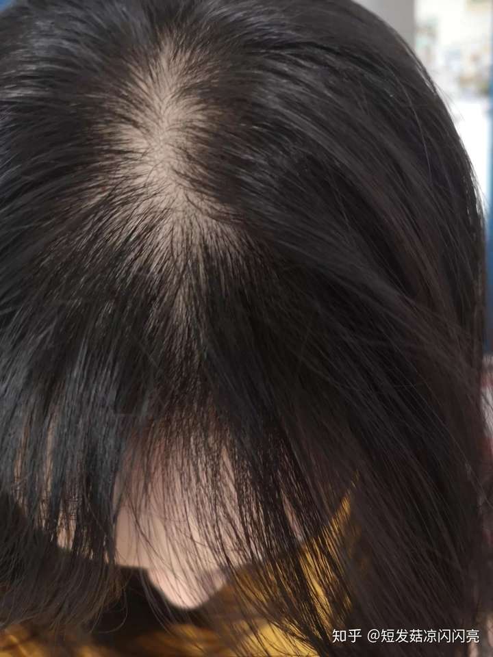 女性头顶头发稀少图片