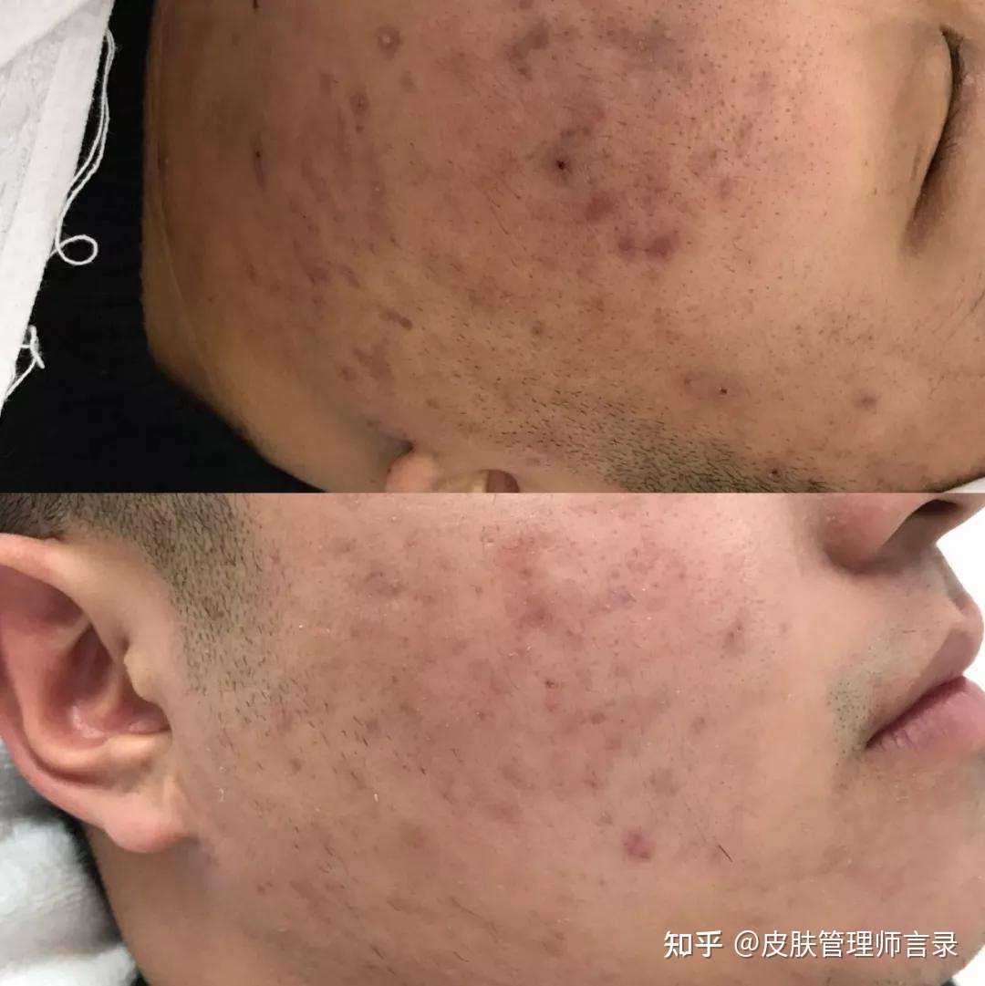 皱纹色斑该怎么去除 知乎