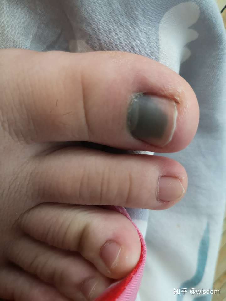 脚被砸到了,昨天夜里疼了一夜,硬是没睡着,哭了