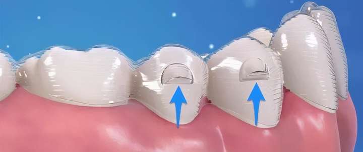 隐形牙套附件是什么东西