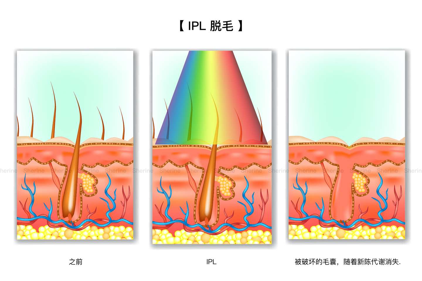 一篇文章了解激光脱毛 Ipl脱毛 冰点脱毛 其他各种脱毛方法 知乎