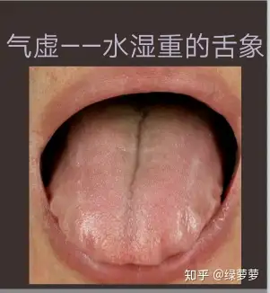 氣虛體質水溼重人的舌象