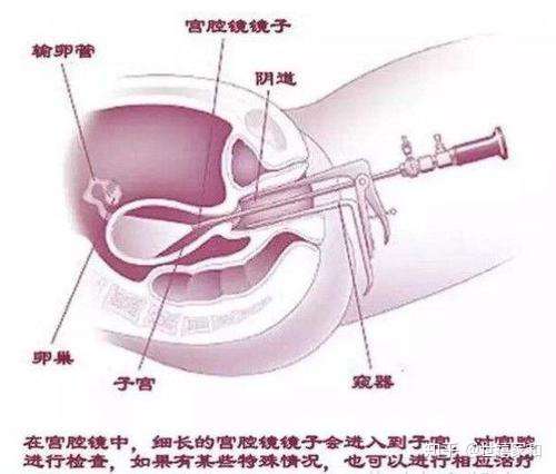 宫颈纳囊怎么治疗图片