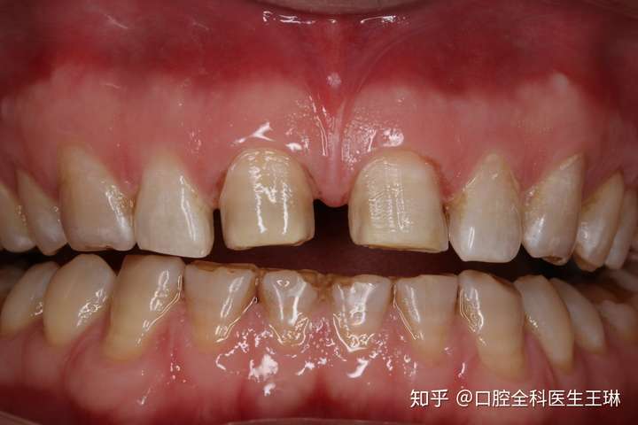 牙缝宽大需警惕别让自己变成漏财牙