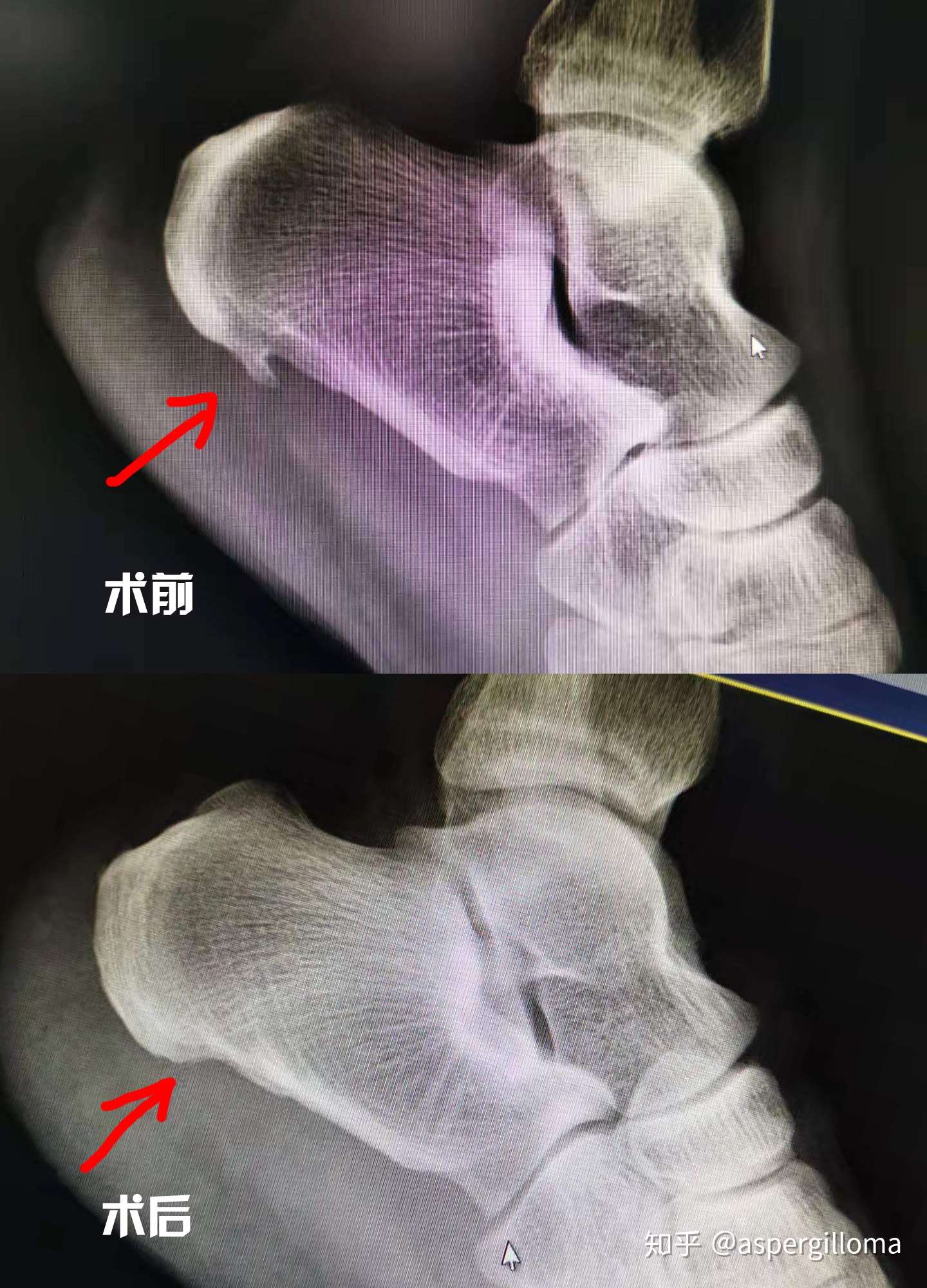 跟骨骨刺保守治疗无效后可以考虑微创手术治疗 知乎