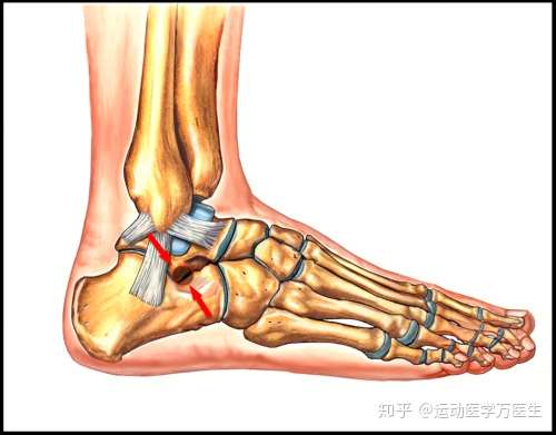 崴脚专业户注意 这个地方的深部疼痛 可能是 跗 Fu 骨窦综合症 知乎