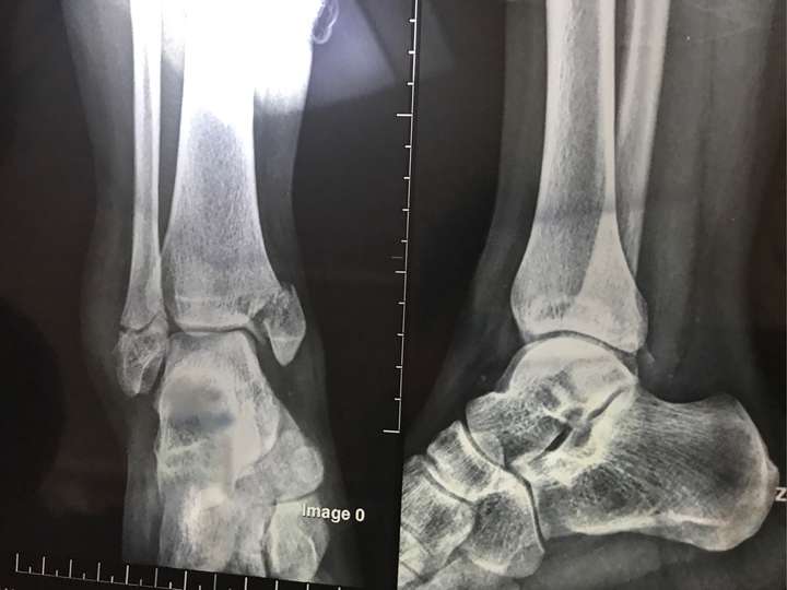 脚踝骨折怎么做才能恢复的快