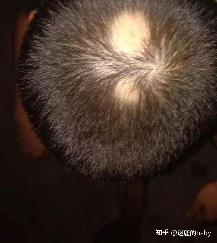 关于肾阴虚引起的脱发问题?