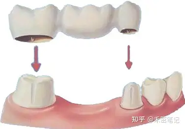 常見的修復缺失牙的方法有三種,即活動義齒,固定義齒,種植牙,到底該