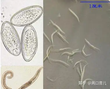 患有"蛲虫病"后,怎样进行治疗和预防呢?