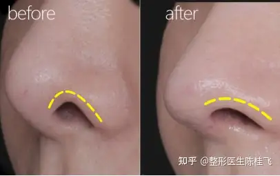 鼻孔外露有几种情况?都是如何改善的呢?