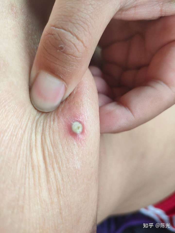 头皮上常长脓包,随便一碰就破了有黄色的浓.有时候会痒还有疼痛感.