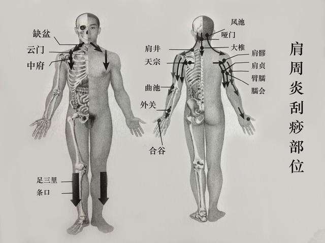 肩周炎 肱二头肌肌腱损伤 肩峰下滑囊炎刮一刮这几个部位 知乎