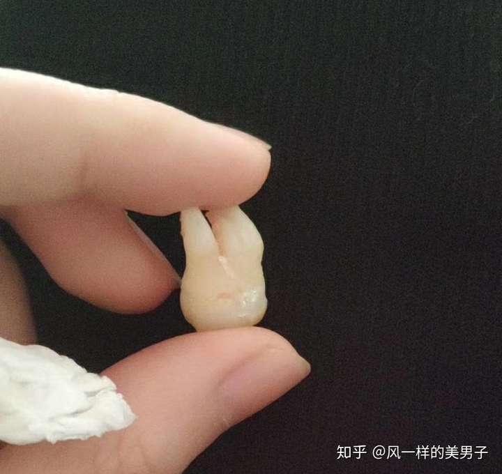 想听听大家拔智齿的经历都是怎样的?