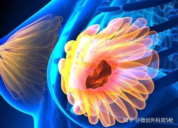 乳腺增生和乳腺癌有沒有關係