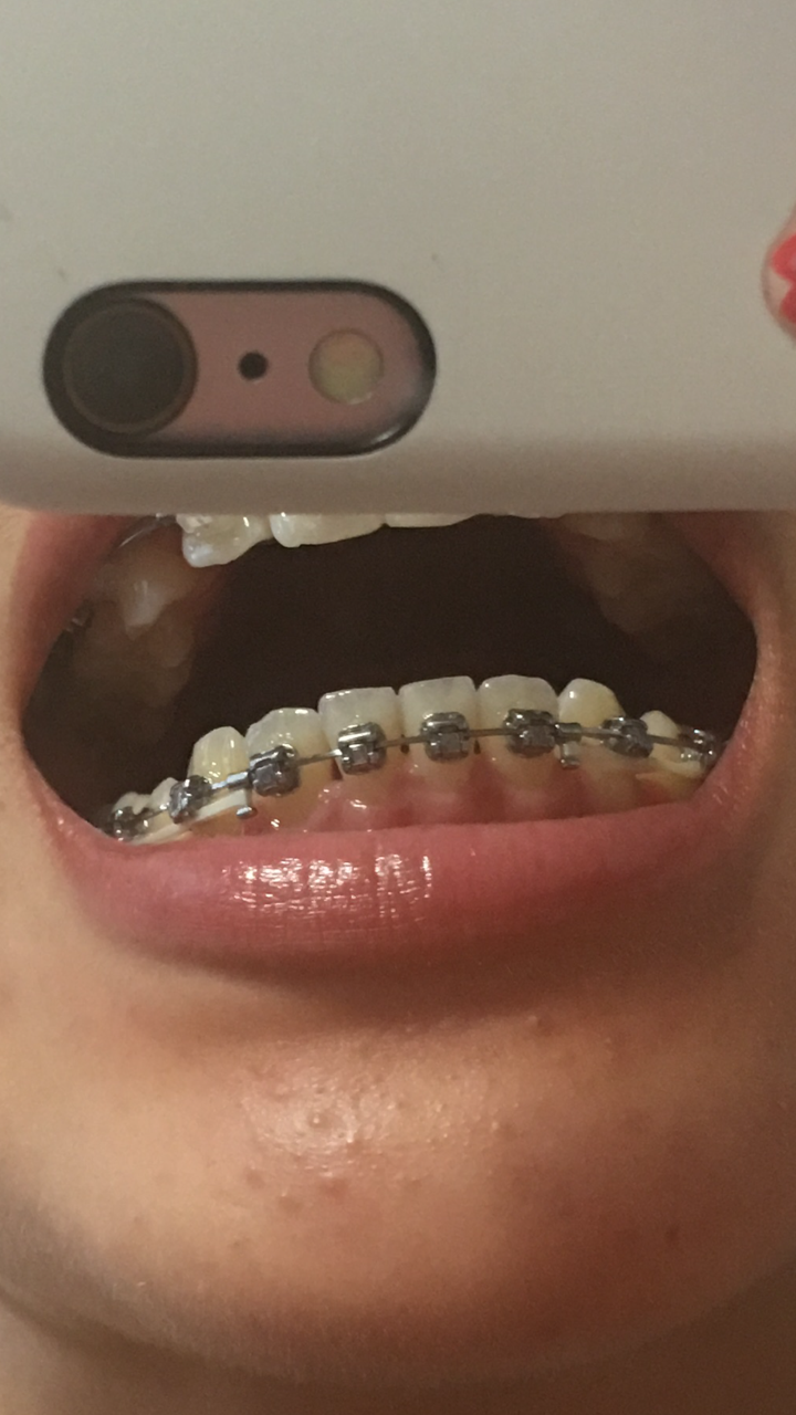 看图我也是,前四颗牙的三个缝都有,左边的最严重,现在就是用牙缝刷,我