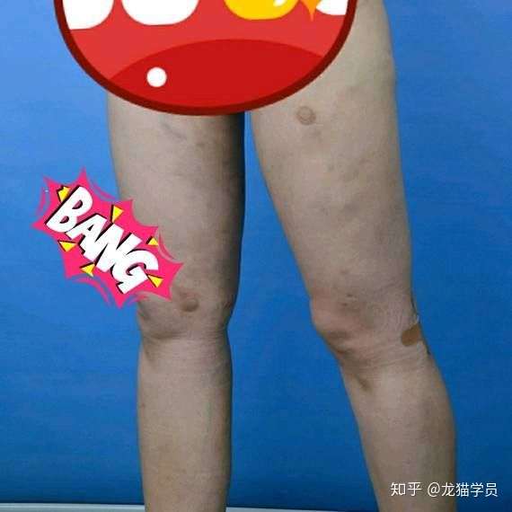 说实在的 大腿抽脂到底会不会凹凸不平,坑坑洼洼.