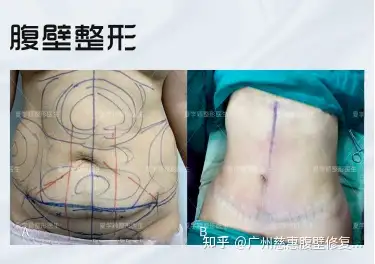 (夏学颖腹壁成形术真实案例)产后腹直肌分离间距过大,且妊娠纹严重