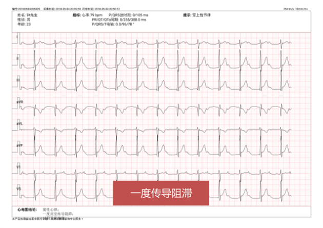 轻松看懂体检心电图 再也不用担心被吓着了 知乎