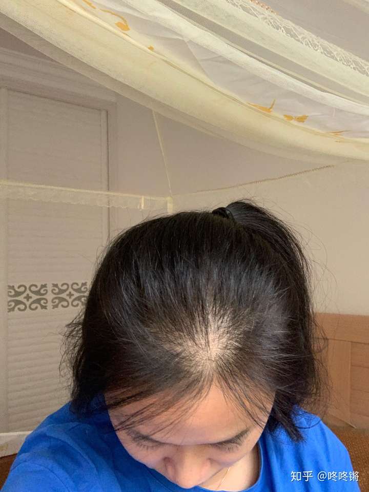 为什么我发量挺多的,但是就头顶刘海的分界线那里感觉很秃?