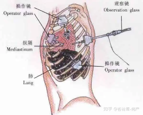 什么是肺癌的微创手术？有何优点- 知乎