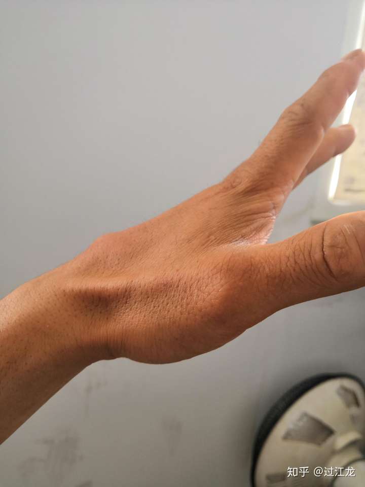 手背与胳膊之间的筋脉上面起了一个小疙瘩那是怎么回事儿?