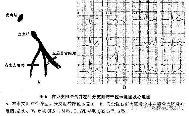 心电图解读 讲座系列 第7 讲 束支阻滞心电图 知乎