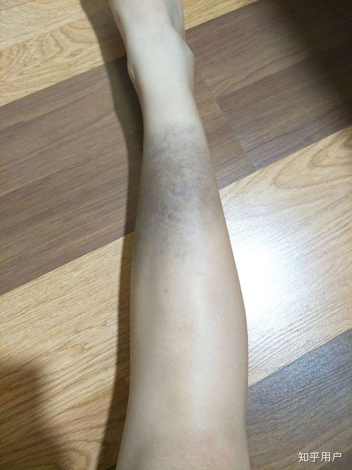 你见过什么特殊的胎记