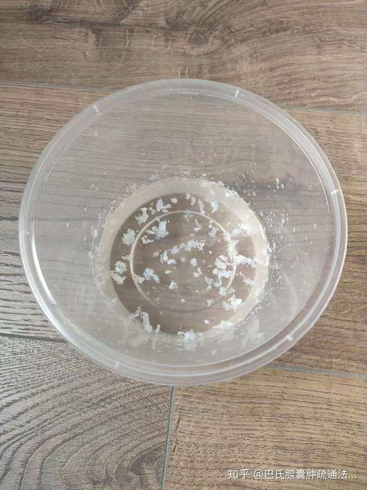 巴氏腺囊肿才两年,能有80个毫升,像粥一样,非常稠厚,用大针都非常难抽