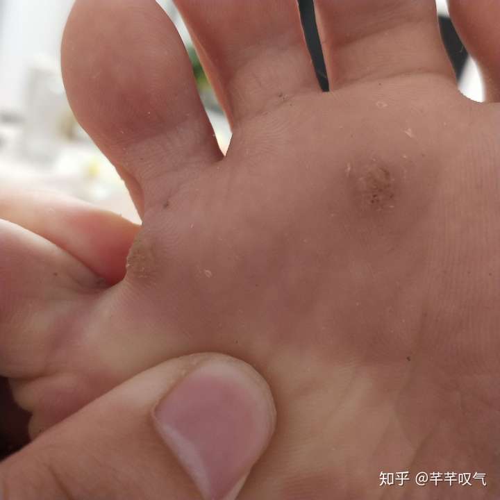 鸦胆子治疣的方法 zhuanlan.zhihu.com