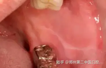口腔内有一条凸起白线舌上长肉疙瘩这些是病变吗