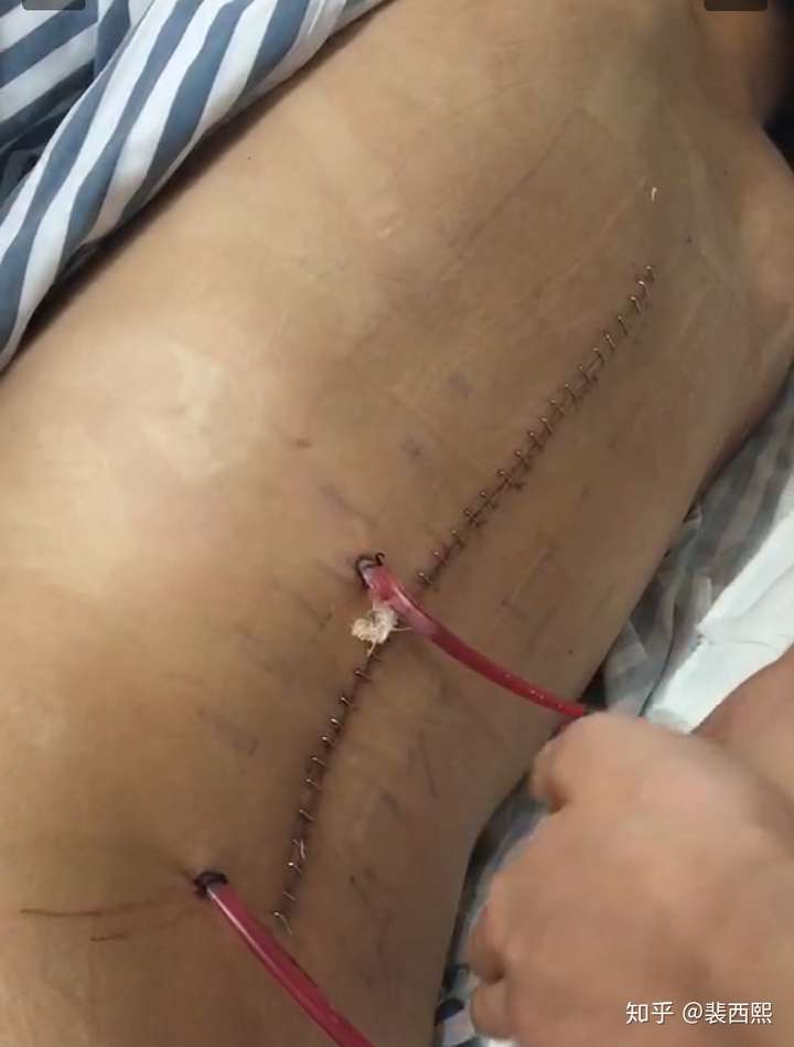 脊柱侧弯术后伤疤图片图片