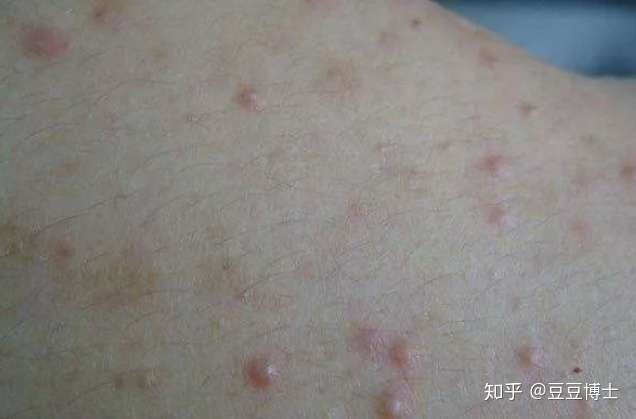 毛囊炎的病因知多少？ - 知乎