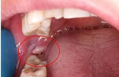 干槽症是拔牙所导致急性感染的一种,多发生在下颌智齿拔除后,由于口腔