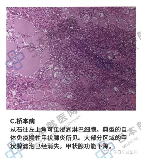 炎症解读5 自体免疫疾病 知乎